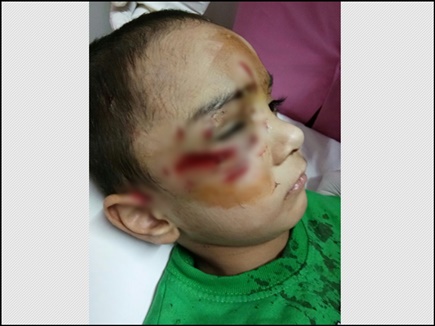 Photo of MP के भोपाल में डॉग बाइट का शिकार हुआ बच्चा, करानी पड़ी सर्जरी