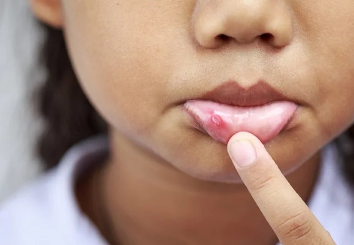 Photo of अगर रोजाना रहते हैं मुंह में छाले तो अभी हो जाएं अलर्ट, कैंसर तक हो सकता है आपको