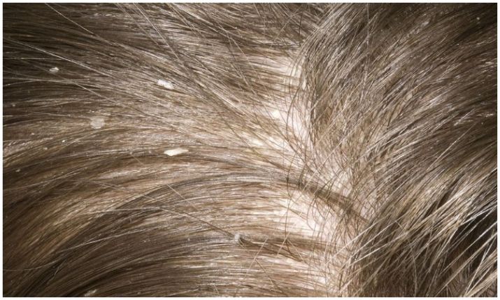 Photo of बालों के लिए सबसे बड़ी समस्या बनता जा रहा है डैंड्रफ, ऐसे करें उपचार…