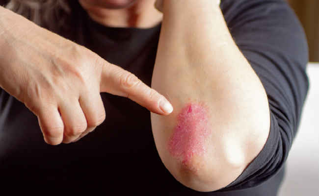 Photo of SOLARISIS से बचने के लिए कुछ इस तरह के करें उपाय