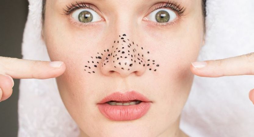 Photo of लेमन से पाएं ब्लैक हेड से छुटकारा, निखरेगा चेहरा