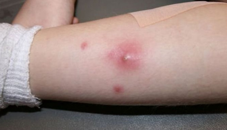 Photo of बालतोड़ की छोटी समस्या बन सकती है बहुत बड़ी, इन उपायों से जल्द करें इसका इलाज