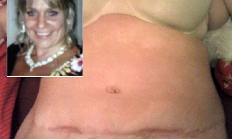 Photo of फिट दिखने के लिए इस महिला ने कराई सर्जरी, फिर अचानक फट गया पेट और…