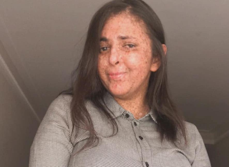 Photo of इस महिला को है 20 साल से  अजीबोगरीब, धूप में निकलने से जा सकती है जान