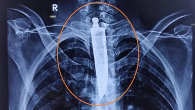 Photo of इस युवक को लोहा खाना पड़ा भारी, फेफड़े में जा फंसा 6 इंच का…