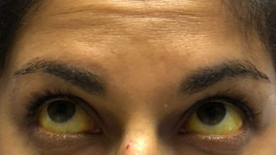 Photo of पीलिया के मरीजो को जरूर पता होनी चाहिए ये खास बातें…