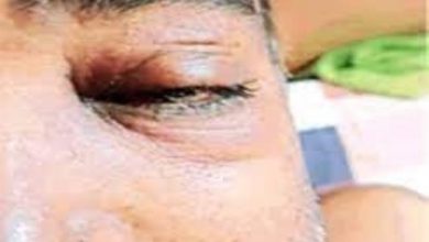 Photo of उत्तराखंड में हुई ब्लैक फंगस संक्रमण की पुष्टि, दो मरीजों में दिखें लक्षण…
