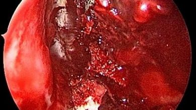 Photo of डॉक्टर के लिए एक और चुनौती, मरीज में दिखे ब्लैक के साथ व्हाइट और यलो फंगस के लक्षण