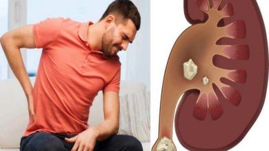 Photo of किडनी स्टोन के दर्द से तुरंत मिलेगा आराम, बस करें ये  खास उपाय…