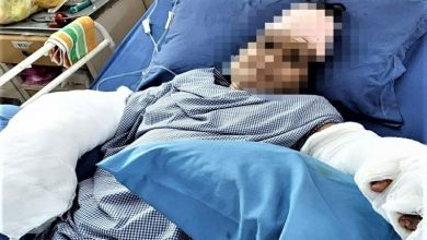 Photo of महिला के कटे दोनों हाथों को जोड़ने में राजधानी के डाक्टरों ने हासिल की बड़ी सफलता