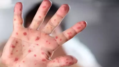 Photo of देश में मिले मंकीपॉक्स के पहले मरीज को अस्पताल से मिली छुट्टी￼