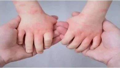 Photo of यूपी: लखनऊ में 12 बच्चों में दिखे टोमैटो फ्लू के लक्षण, मचा हडकंप￼