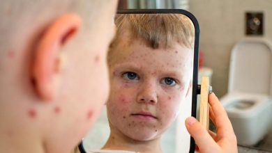 Photo of जानें कैसे होते है खसरा के लक्षण..