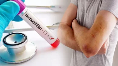 Photo of जानें हीमोफीलिया क्या गंभीर बीमारी, इसके लक्षण और इसका ट्रीटमेंट-