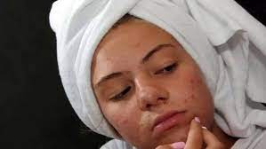 Photo of आपके एक्ने की समस्या को और बढ़ा सकती है आपकी ये 5 गलतियां…