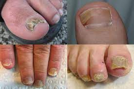 Photo of पैर के नाखूनों में लग गया है फंगस तो समय रहते घरेलू उपचार से इन्हें ठीक किया जा सकता…