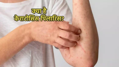 Photo of क्या है स्किन से जुड़ी केराटोसिस पिलारिस की समस्या? जानिए