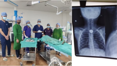 Photo of मध्य प्रदेश: बच्चे के गले में फंसे सिक्के को जीएमसी के डॉक्टरों ने निकाला बाहर