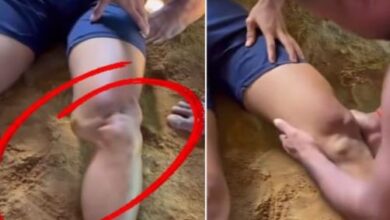 Photo of खिसक गई थी पैर की हड्डी, दिखने लगी थी अलग-अलग, मास्टर जी ने किया चमत्कार