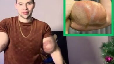 Photo of हाथ में सूई से भर-भर घुसेड़ा 6 लीटर वैसलिन, बांह फुलकर हुआ गुब्बारा
