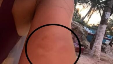 Photo of घूमने गई थी महिला, कीड़े के काटने से लाल हुआ हाथ