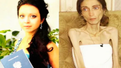 Photo of पति को फूले गाल से थी दिक्कत, पत्नी बन गई चलता-फिरता कंकाल, सूरत ऐसी हुई