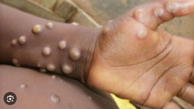 Photo of MPox की रोकथाम के लिए डब्ल्यूएचओ ने शुरू की योजना