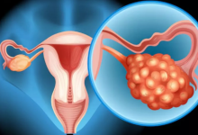 Photo of Ovarian Cyst होने पर शरीर में नजर आते हैं ये लक्षण, जानें कारण और बचाव के तरीके