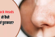 Photo of Black Heads हटाने के लिए आजमाएं 4 नुस्‍खे