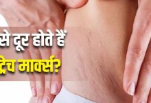 Photo of क्या नारियल तेल लगाने से गायब हो जाते हैं स्ट्रेच मार्क्स?