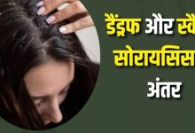 Photo of सिर में होने वाली खुजली सिर्फ डैंड्रफ है या स्कैल्प सोरायसिस का संकेत?