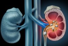 Photo of लाइफस्टाइल की ये तीन गतली बढ़ा देती है किडनी स्टोन का खतरा