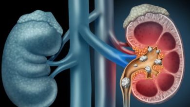 Photo of लाइफस्टाइल की ये तीन गतली बढ़ा देती है किडनी स्टोन का खतरा