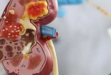 Photo of किडनी डैमेज होने पर सुबह दिखते हैं ये 5 लक्षण