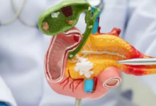 Photo of क्यों नहीं पहचान आते पैंक्रियाटिक कैंसर के लक्षण? जाने