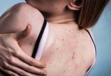 Photo of सिर्फ चेहरे ही नहीं, पीठ पर भी हो सकते हैं एक्ने, बैकने से छुटकारा पाने के लिए आजमाएं ये 5 टिप्स