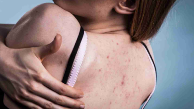 Photo of सिर्फ चेहरे ही नहीं, पीठ पर भी हो सकते हैं एक्ने, बैकने से छुटकारा पाने के लिए आजमाएं ये 5 टिप्स