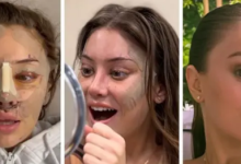 Photo of 20-30 साल की महिलाओं में बढ़ रहा फेसलिफ्ट का क्रेज