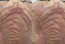 Photo of क्रीम लगाकर सोई महिला, सुबह उठी तो बन गया नागिन जैसा शरीर