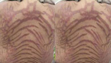 Photo of क्रीम लगाकर सोई महिला, सुबह उठी तो बन गया नागिन जैसा शरीर