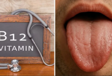 Photo of जीभ पर दिखते हैं विटामिन-B12 की कमी के 3 बड़े संकेत