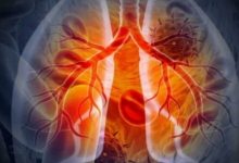 Photo of फेफड़ों के कैंसर के खिलाफ बड़ी कामयाबी