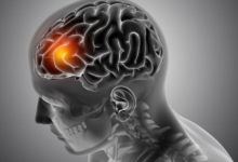 Photo of देश में तेजी से बढ़ रहीं न्यूरोलॉजिकल बीमारियां
