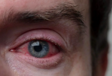 Photo of जिसे साधारण एलर्जी समझ रहे हैं, कहीं वो अर्बन आई सिंड्रोम तो नहीं?