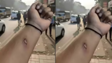 Photo of एआई से बनाई नकली चोट की फोटो भेजी और मिल गई छुट्टी