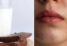 Photo of दूध पीने या चॉकलेट खाने से क्या सच में होते हैं पिंपल्स? डर्मेटोलॉजिस्ट ने खोला राज