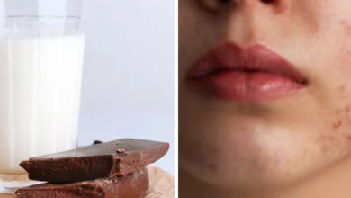 Photo of दूध पीने या चॉकलेट खाने से क्या सच में होते हैं पिंपल्स? डर्मेटोलॉजिस्ट ने खोला राज