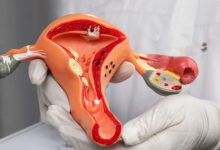 Photo of शरीर में दिखने वाले ये 4 लक्षण करते हैं सर्वाइकल कैंसर का इशारा