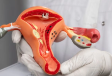 Photo of सर्वाइकल कैंसर से हर 7 मिनट में हो रही एक महिला की मौत