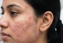 Photo of मामूली रेडनेस या स्किन इन्फेक्शन का संकेत? डर्मेटोलॉजिस्ट ने बताया कैसे करें पहचान